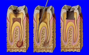 Liječenje zubi - Endodoncija